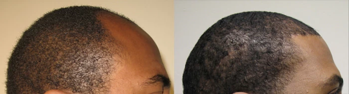 Patient p55 hair transplant before and after right view