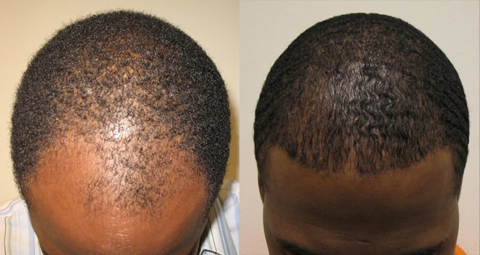 Patient p55 hair transplant before and after tilt view