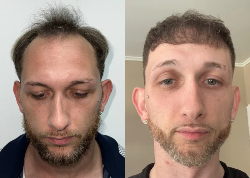 Jermey Hair Transplant Before and After