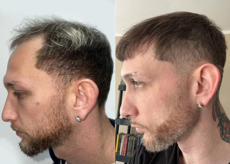 Patient p560 hair transplant before and after left view