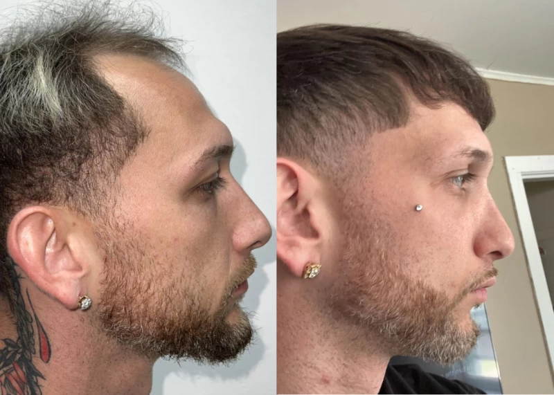 Patient p560 hair transplant before and after right view