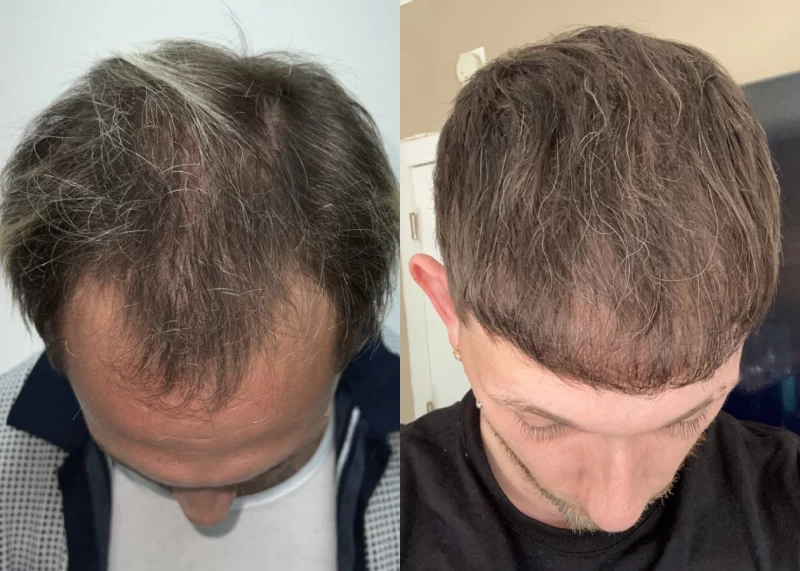 Patient p560 hair transplant before and after tilt view