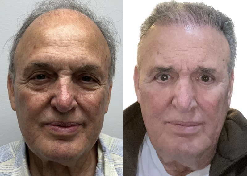 Charlie Hair Transplant Before and After
