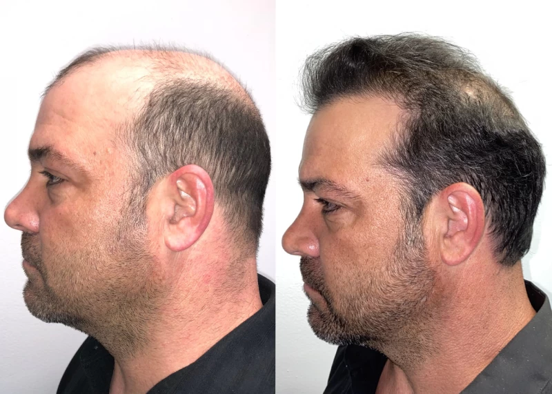 Patient p562 hair transplant before and after left view