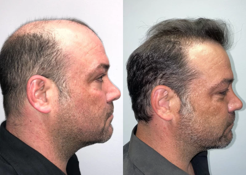 Patient p562 hair transplant before and after right view