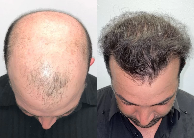 Patient 562 Hair Transplant Before and After