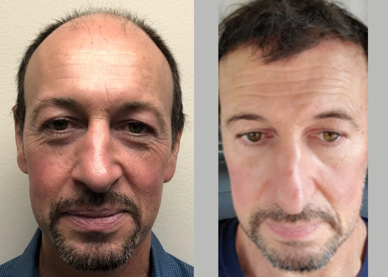 Patient 563 Hair Transplant Before and After