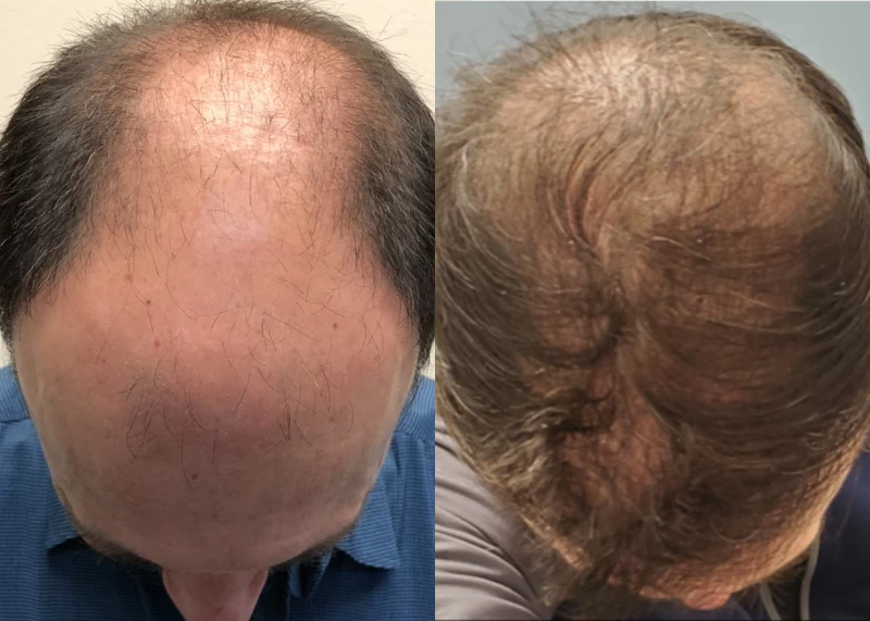 Patient p563 hair transplant before and after tilt view