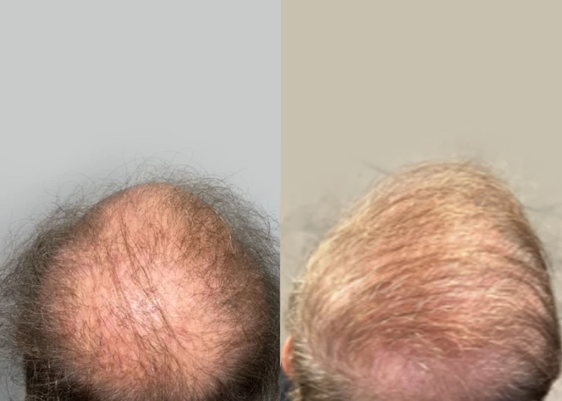 Patient p564 hair transplant before and after crown view