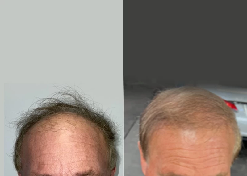 Patient 564 Hair Transplant Before and After