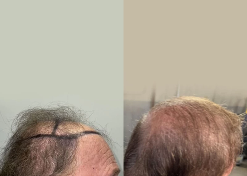 Patient p564 hair transplant before and after right view