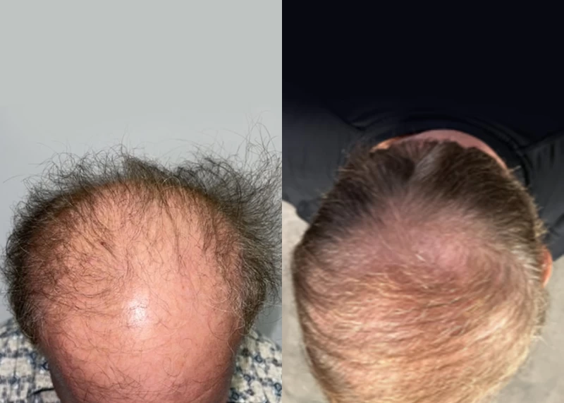 Patient p564 hair transplant before and after tilt view