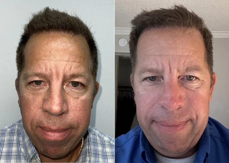 Charlie Hair Transplant Before and After