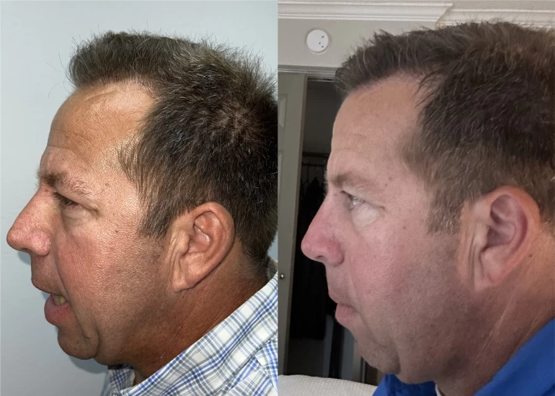 Patient p565 hair transplant before and after left view