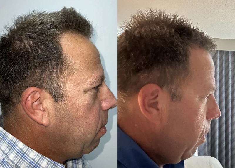 Patient p565 hair transplant before and after right view