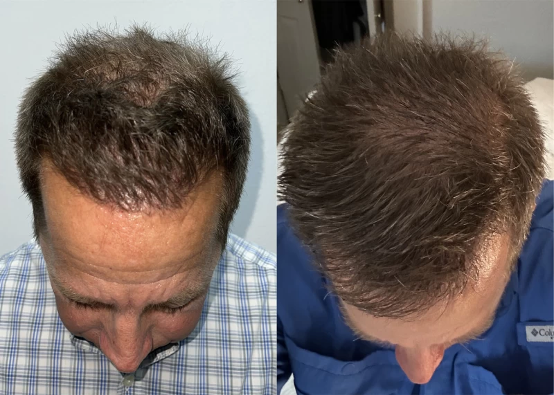 Patient p565 hair transplant before and after tilt view