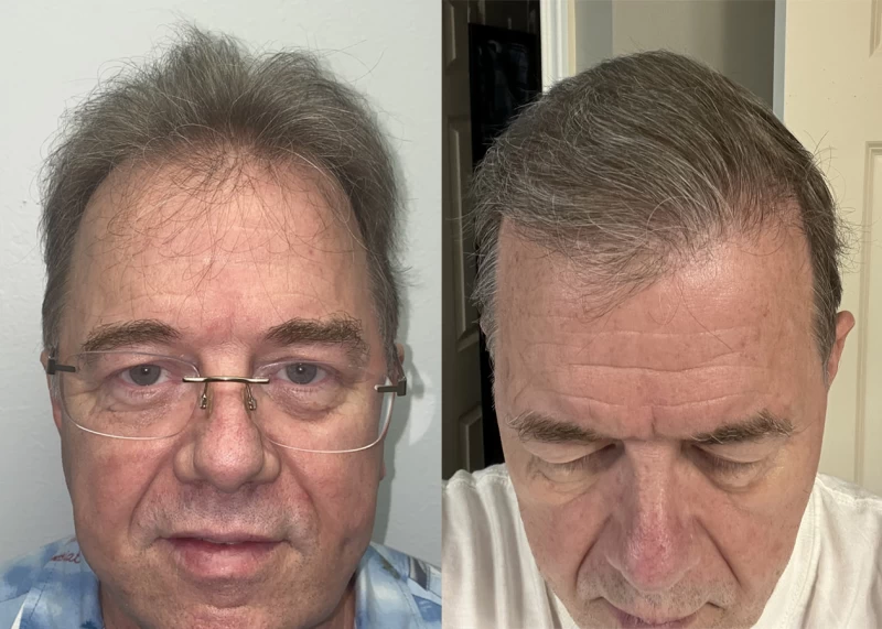 Darrel Hair Transplant Before and After