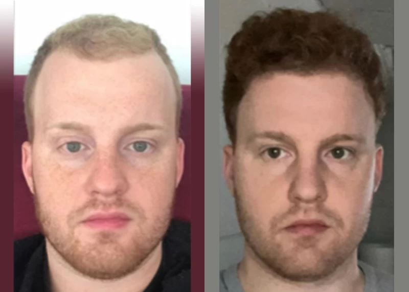 Patient 567 Hair Transplant Before and After