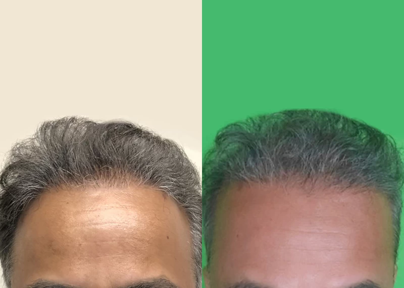 Patient 568 Hair Transplant Before and After