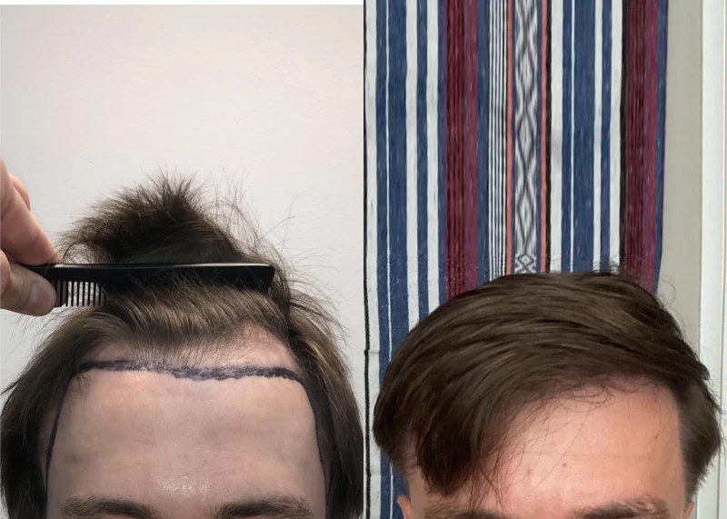 Patient 569 Hair Transplant Before and After