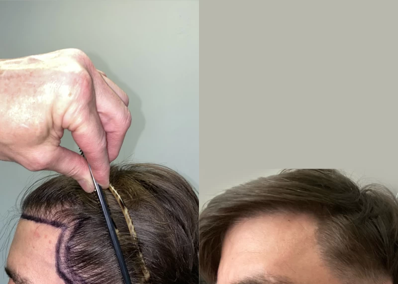 Patient p569 hair transplant before and after left view