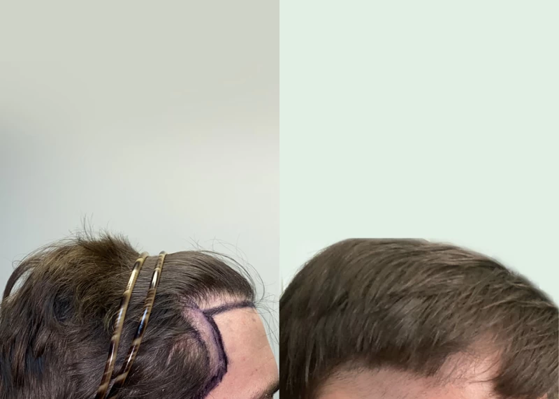 Patient p569 hair transplant before and after right view