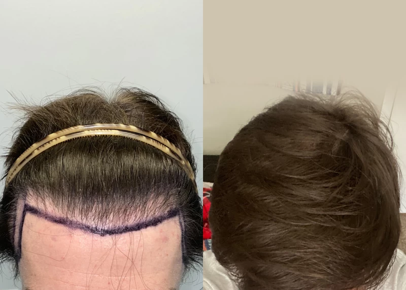 Patient p569 hair transplant before and after tilt view