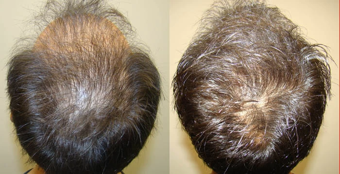Patient p56 hair transplant before and after crown view
