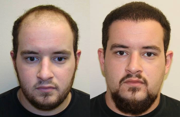 Jeremy Hair Transplant Before and After