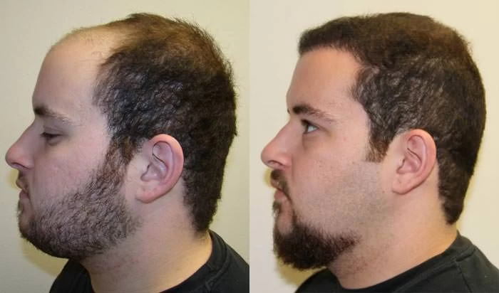 Patient p56 hair transplant before and after left view