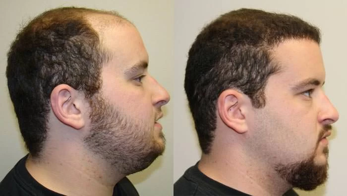 Patient p56 hair transplant before and after right view