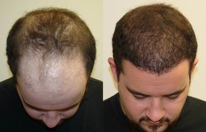 Patient p56 hair transplant before and after tilt view