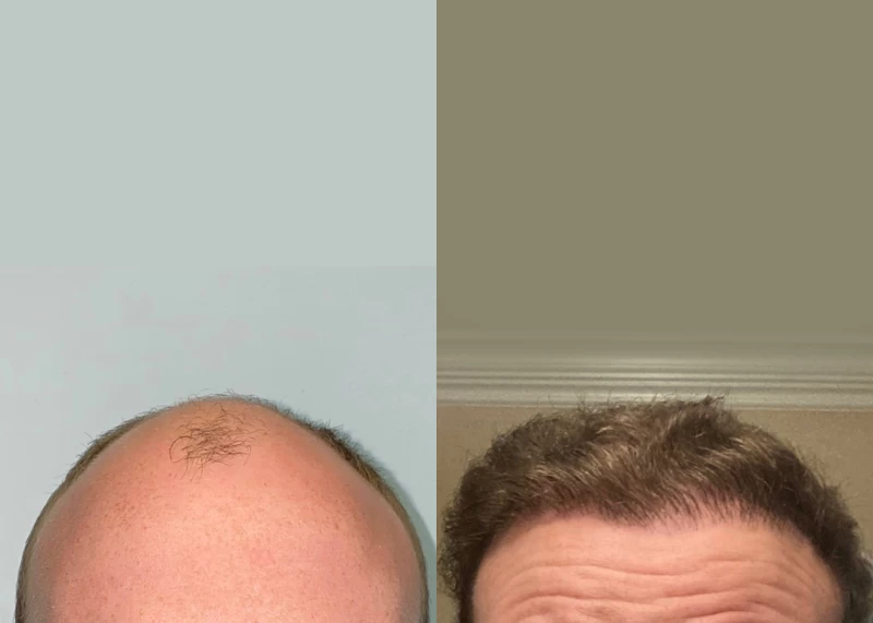 Patient 570 Hair Transplant Before and After