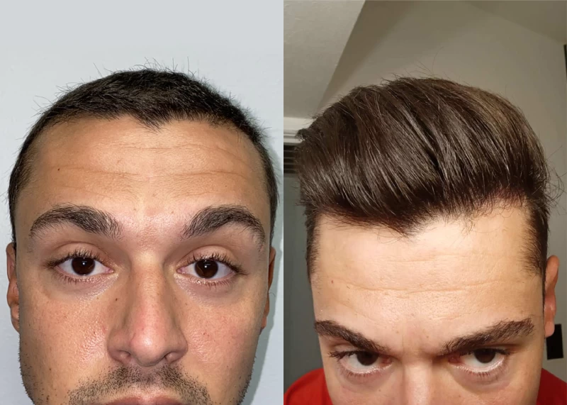 Patient 571 Hair Transplant Before and After