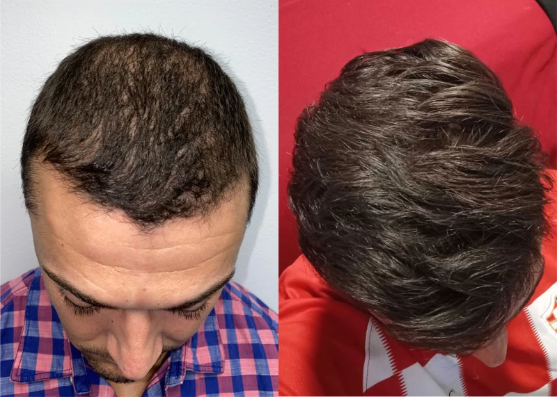 Patient p571 hair transplant before and after tilt view