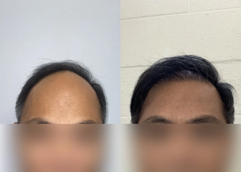 Patient 573 Hair Transplant Before and After