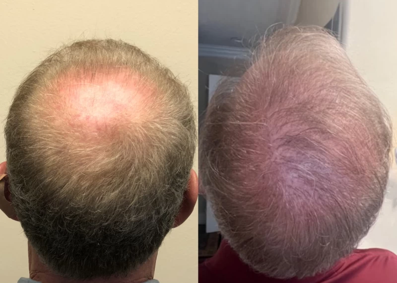 Patient p574 hair transplant before and after crown view