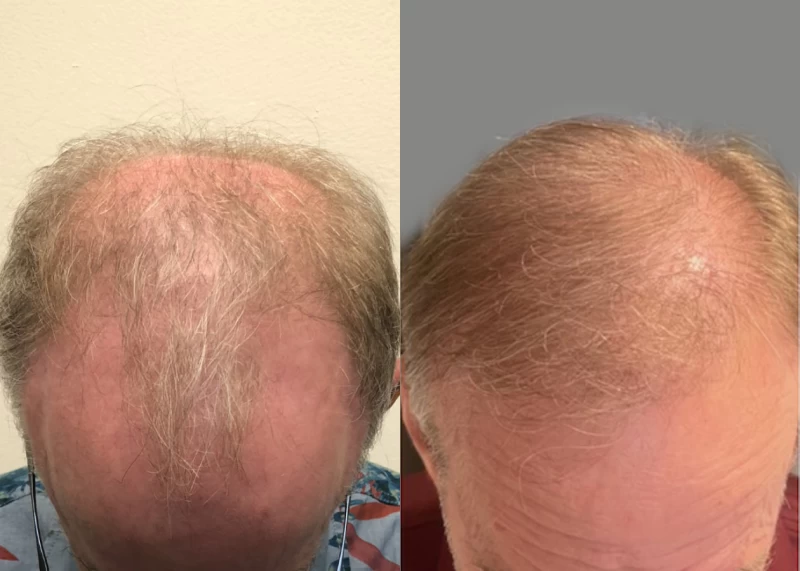 Patient 574 Hair Transplant Before and After