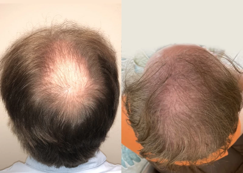Patient p575 hair transplant before and after crown view