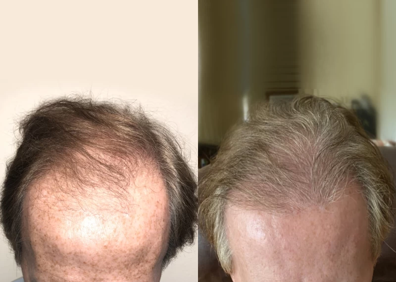 Patient 575 Hair Transplant Before and After