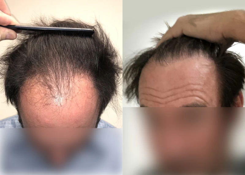 Patient 576 Hair Transplant Before and After