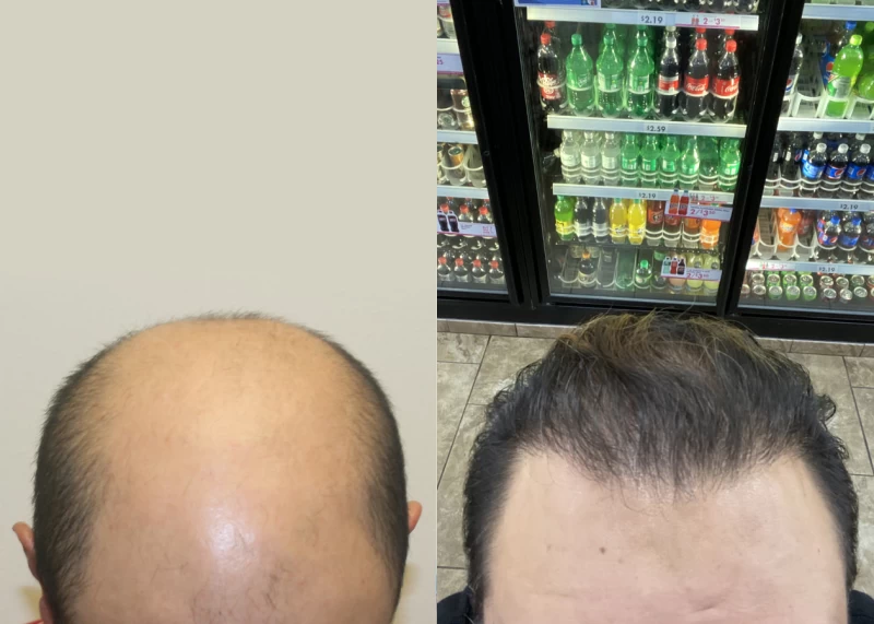 Patient 578 Hair Transplant Before and After