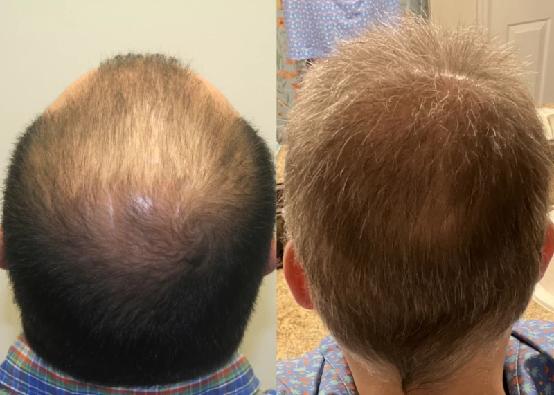 Patient p579 hair transplant before and after crown view