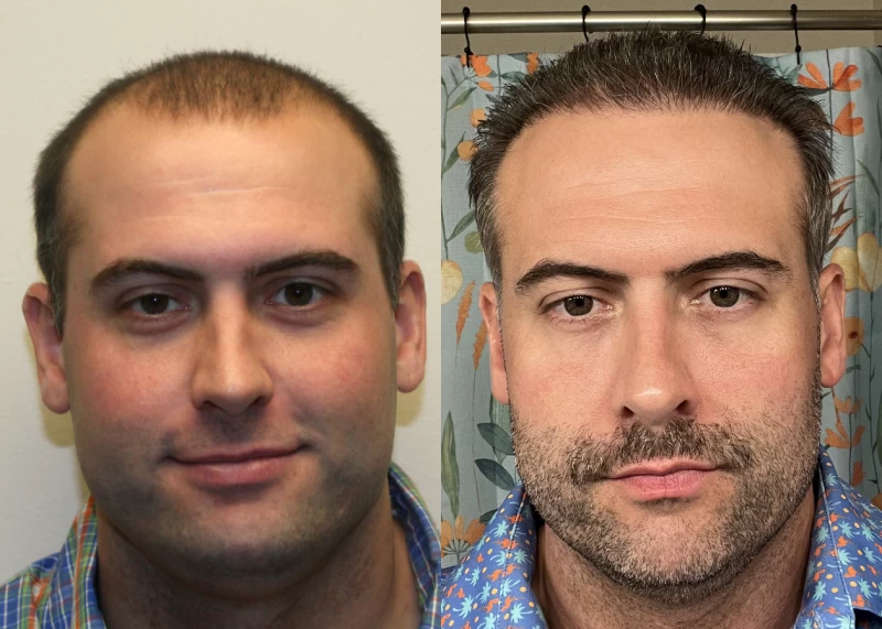 Patient 579 Hair Transplant Before and After