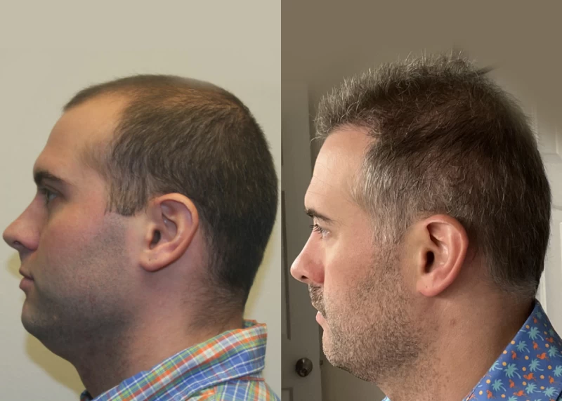Patient p579 hair transplant before and after left view