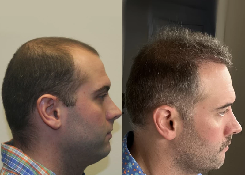 Patient p579 hair transplant before and after right view