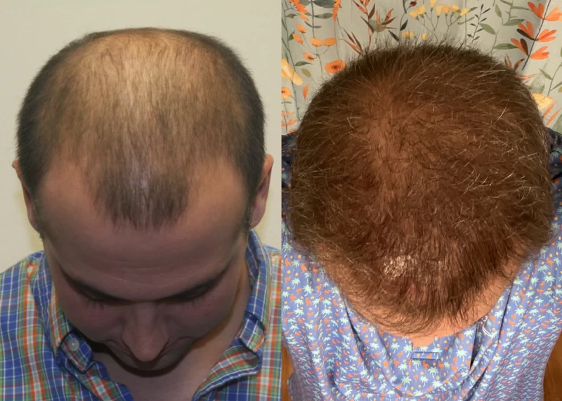 Patient p579 hair transplant before and after tilt view