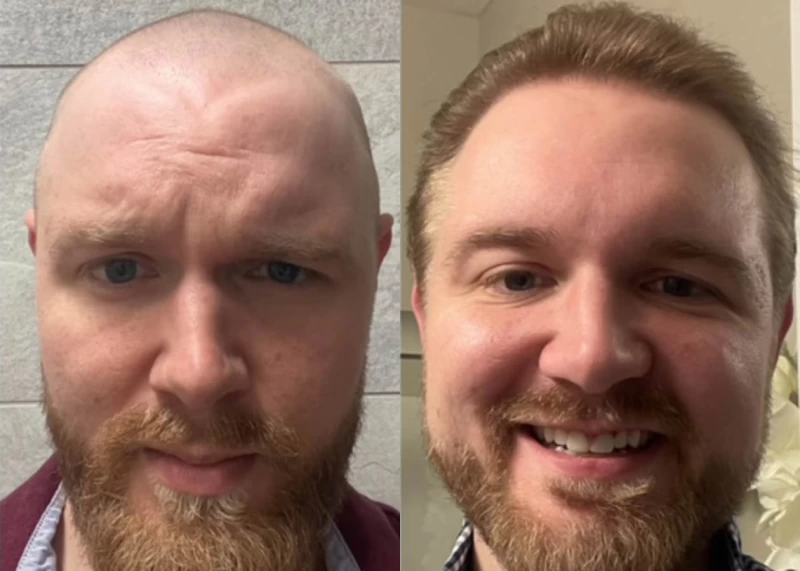 Patient 580 Hair Transplant Before and After