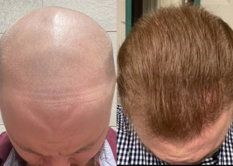 Patient p580 hair transplant before and after tilt view