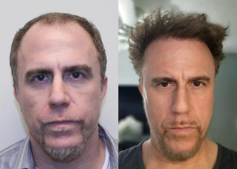 Patient 581 Hair Transplant Before and After